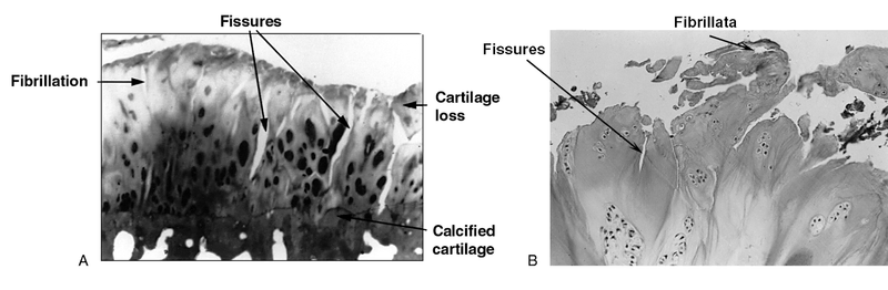Osteoarthritis Osteoarthritis
