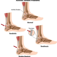 Ankle Injury Treatment NYC | Ankle Injury Specialists