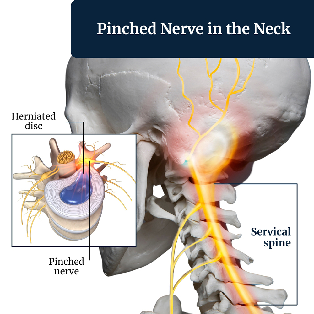 pinched-nerve-in-the-neck-treatment-irving-tx